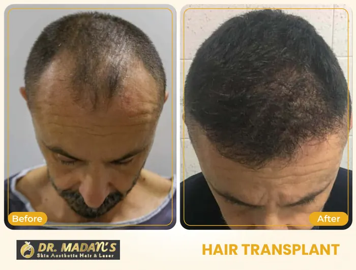 Hair transplant before and after result 1 at Dr Madan Aesthetics